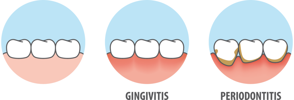 Diferencia entre la Gingivitis y la Periodontitis