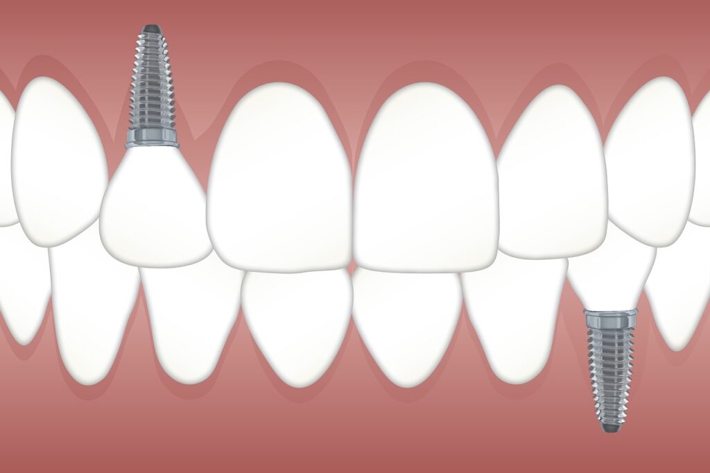 implantes dentales en alcorcon