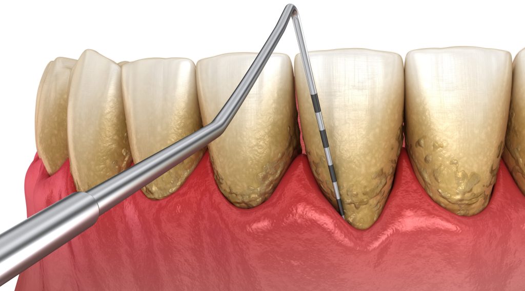 Periodontitis,Testing,,Gum,Recession,Process.,Medically,Accurate,3d,Illustration